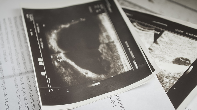 Новые флюорографы, мамографы и рентгенографы появятся Удмуртии
